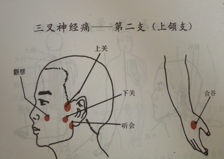 三叉神经痛