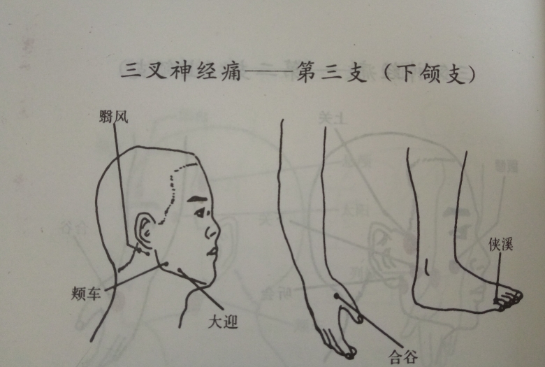 三叉神经痛