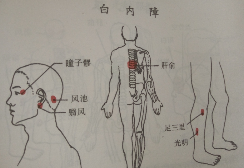 白内障